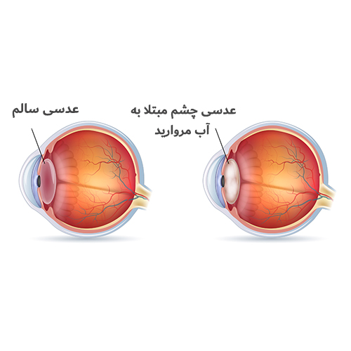 آب مروارید