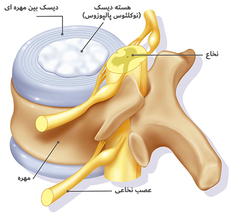 دیسک-گردن دیسک گردن