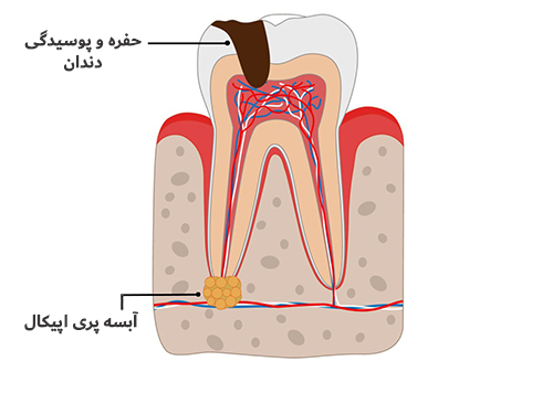 انواع-آبسه-دندان-کودکان انواع آبسه دندان کودکان