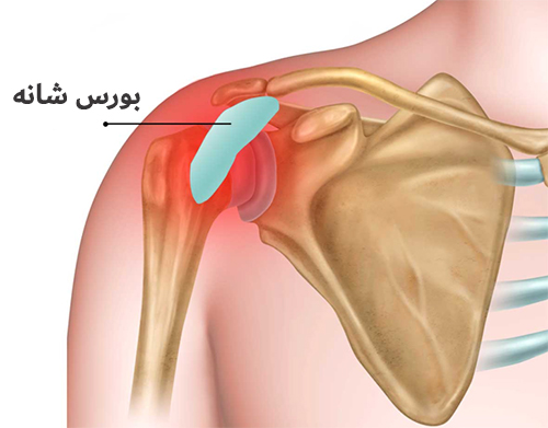 بورسیت شانه