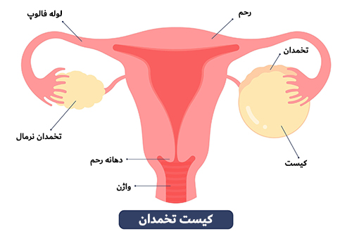 کیست-تخمدان-چیست؟ کیست تخمدان چیست؟